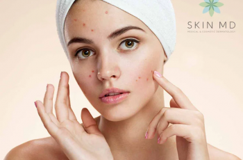 What to Put on Your Face After Acne Extractions