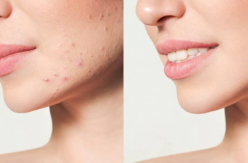 Fillers for Acne Scars: What You Need to Know Fillers for Acne Scars: What You Need to Know